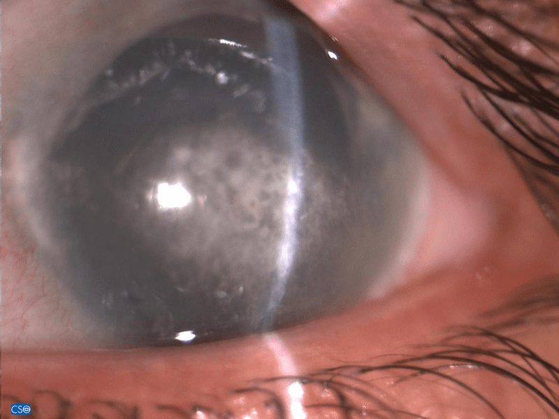 An eye with calcium deposits caused by band Keratopathy 